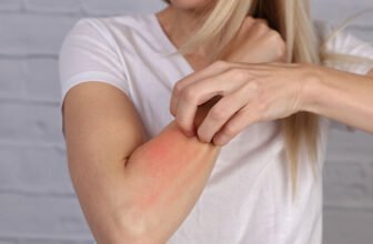 10 Common Allergy Causes