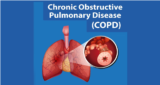 About Chronic Obstructive Pulmonary Disease (Copd)